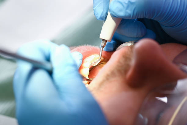 Best Emergency Root Canal Treatment in College Park, MD