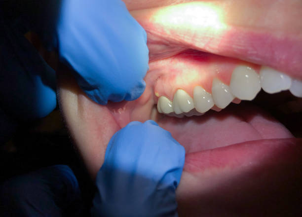 Best Emergency Dental Care for Abscessed Tooth in College Park, MD